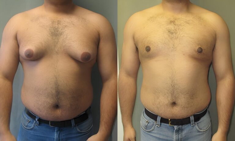 Velikost prsou neřeší jen ženy. Gynekomastie trápí muže i novorozence a nejde jen o vzhled